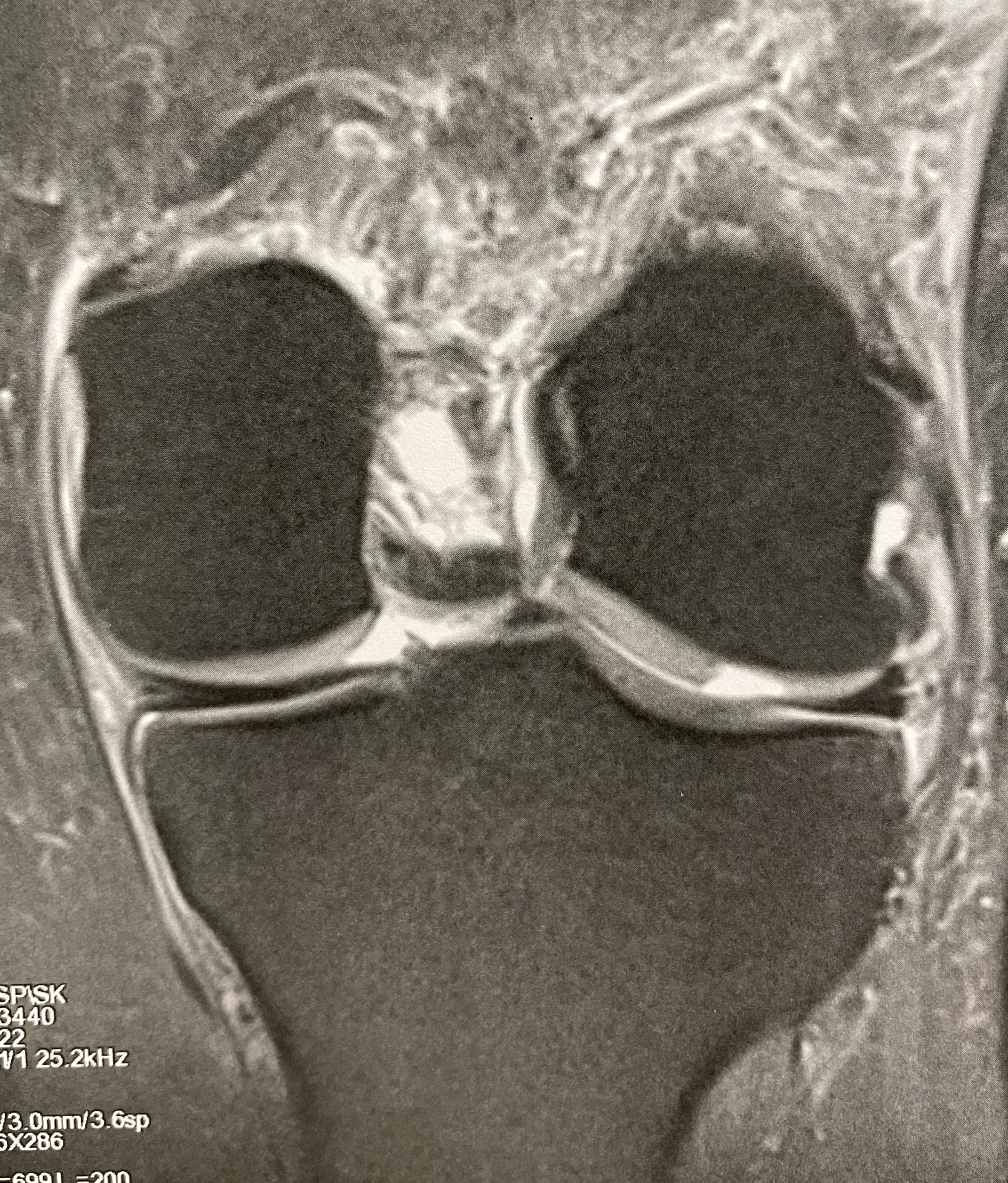 Image Questions fréquentes sur le Plasma Riche en Plaquettes ou PRP.